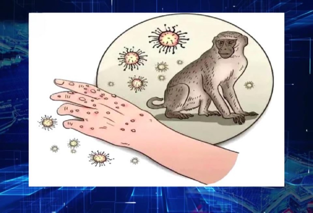 Co potřebujete vědět o viru Monkeypox?