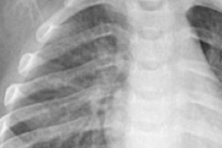 Rychlá detekce chlamydia pneumoniae: spolehlivá a efektivní