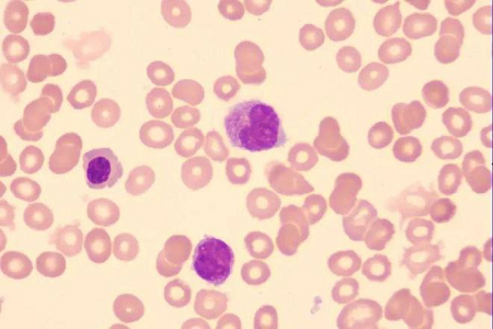 BABIO jednorázový sterilní cytologický cervikální kartáček pro spolehlivý screening ženského zdraví